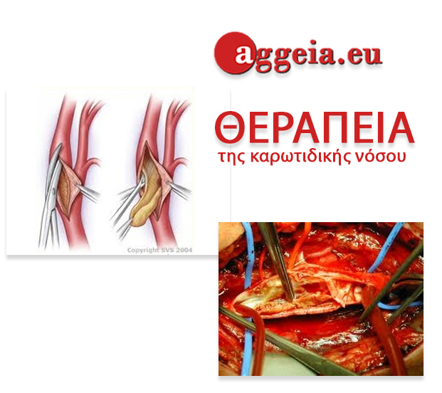 Aggeia.eu - στένωση καρωτίδος - δύο μορφές θεραπείας