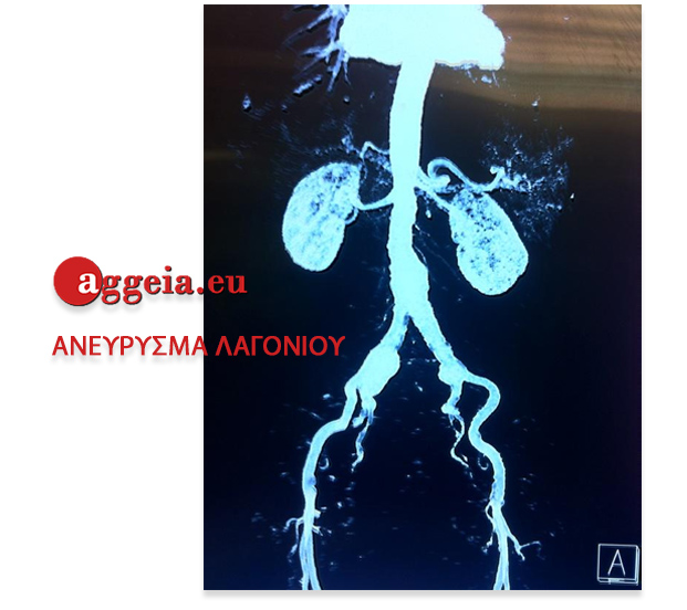ανεύρυσμα λαγονίου - Aggeia.eu - Anevrisma-Lagoniou-AGGEIOHEIROYRGOS-TZORMPATZOGLOY-IOANNIS-MDMSc