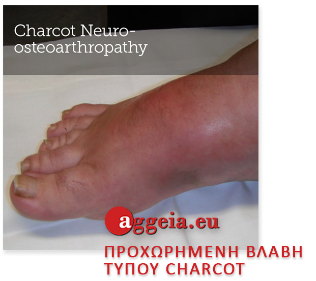 προχωρημένη βλάβη τύπου Charcot- Ulcers - Diabetic Foot - ΘΕΡΑΠΕΙΑ ΔΙΑΒΗΤΙΚΟΥ ΠΟΔΙΟΥ/ΕΛΚΩΝ - Aggeia.eu - elkoi-podion - Διαβητικό πόδι - Περιφερική αγγειακή νόσος