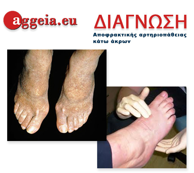 Aggeia.eu - Diagnosi-Apofraktiki-Artiriopatheia-Kato-Akron-Tzorbatzoglou-Ioannis - διάγνωση Αποφρακτικής αρτηριοπάθειας κάτω άκρων