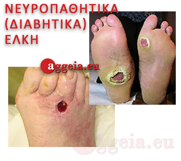 Aggeia.eu -Nevropathitika Elkoi - Tzorbatzoglou-Ioannis - Νευροπαθητικά (Διαβητικά) έλκη
