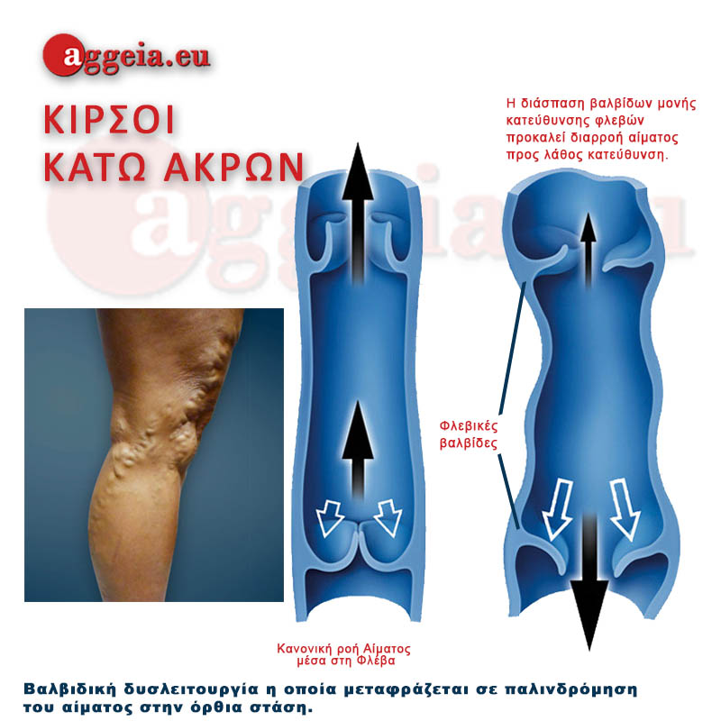 Aggeia.eu -Kirsoi- Tzorbatzoglou-Ioannis - Οι κιρσοί κάτω άκρων Κιρσοί φλεβική ανεπάρκεια