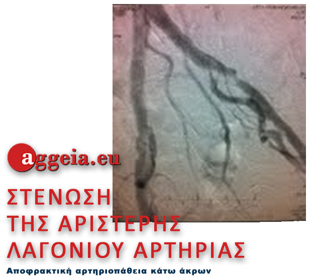 Aggeia.eu - Stenosi-Aristeris-Lagoniou-Artirias-Apofraktiki-Artiriopatheia-Kato-Akron-Tzorbatzoglou-Ioannis-Στην εικόνα που ακολουθεί αναδεικνύεται μία σημαντική στένωση της αριστερής λαγονίου αρτηρίας - διάγνωση Αποφρακτικής αρτηριοπάθειας κάτω άκρων