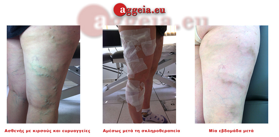 Aggeia.eu -Therapeia Evryaggeies - Ευρυαγγείες