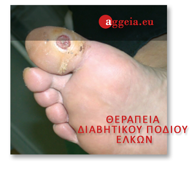 ΘΕΡΑΠΕΙΑ ΔΙΑΒΗΤΙΚΟΥ ΠΟΔΙΟΥ/ΕΛΚΩΝ - Aggeia.eu - elkoi-podion - Διαβητικό πόδι - Περιφερική αγγειακή νόσος