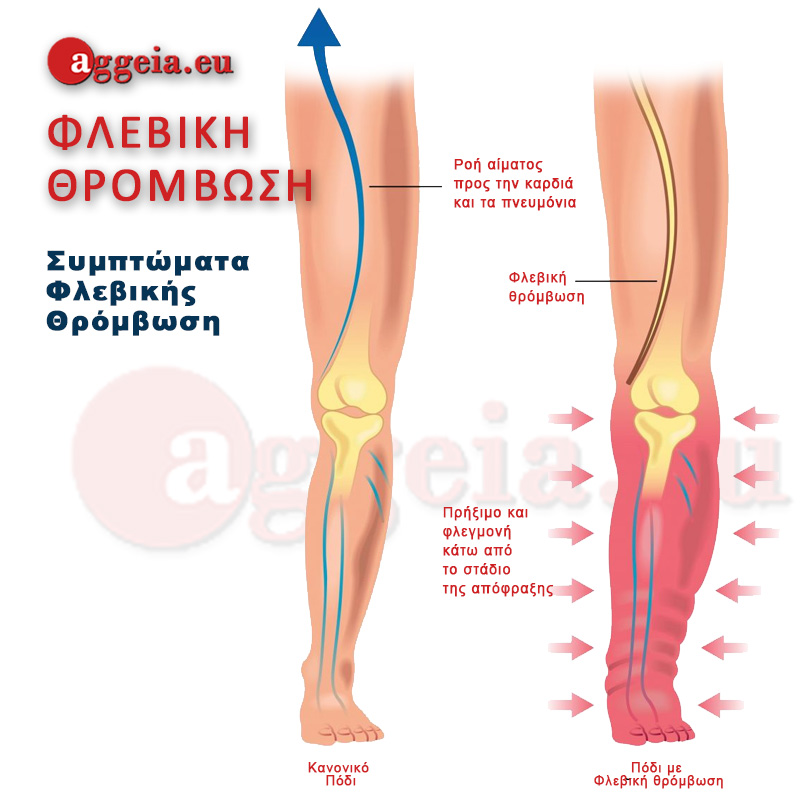 Aggeia.eu -Deep-Vein-Thrombosis Symptoms - Tzorbatzoglou-Ioannis