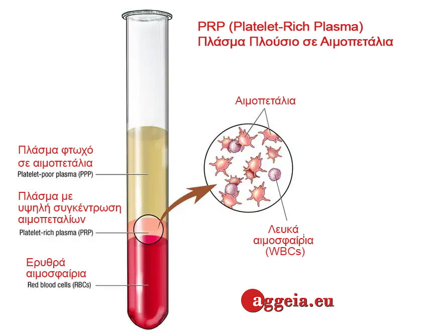 PRP-Platelet-Rich Plasma